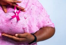 Le cancer du sein au Togo : les conseils du Dr M’BORTCHE Bingo pour la détection précoce et la sensibilisation.